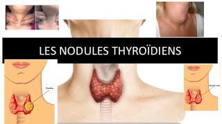 nodule thyroïdienne  part 2 [upl. by Acinaj]