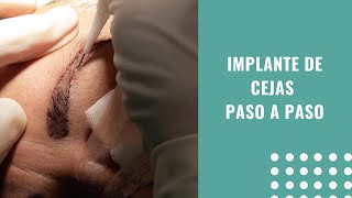 🙋‍‍ Trasplante de Cejas La Dra Laura Caicedo te explica cómo se realiza esta técnica 👏‍‍ [upl. by Oileduab]