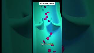 Varicose Veins heart cvs artery vein thrombus [upl. by Elvyn102]