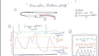 Intraaortic Balloon Pump IABP [upl. by Assirrec352]