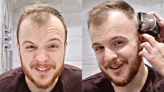 BALDING RECEDING Hairline 0 Buzz Cut Transformation At 24 [upl. by Mirabel]