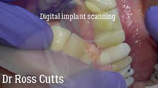 Implant Itero digital scanning [upl. by Wallas]