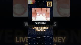 NAIL HEALTH ALERT healthalert nail YouTube [upl. by Erdnassac782]