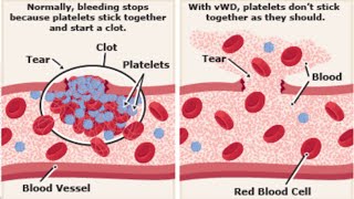 Von Willebrand disease [upl. by Garson355]