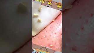 Blackhead Removal Acne Removal Treatment 034 [upl. by Donielle]