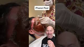 Most Powerful Chemical Peel 😱 shorts [upl. by Ecnaralc676]