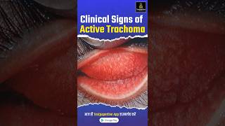 Clinical signs of active trachoma trachoma Clinicalsigns eye ophthalmology testpaperlive [upl. by Felix]