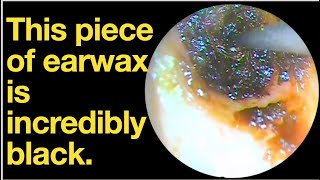 This piece of earwax is incredibly blackear wax removal  ear cleaning  ASMR  relaxation  relax [upl. by Inaliak]