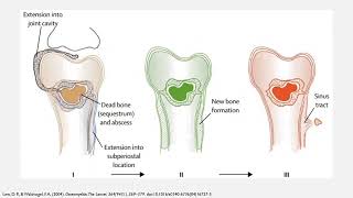 Osteomielitis [upl. by Saraiya256]