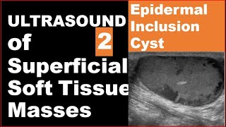 Epidermoid inclusion cyst on Ultrasound [upl. by Joh]