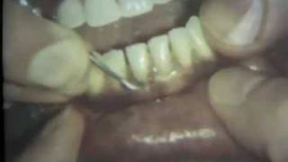 Scaling and Root Planing Part II Mandibular Teeth [upl. by Yme]