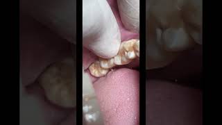 Molar tooth mobility dentalcare [upl. by Ardnasirk]