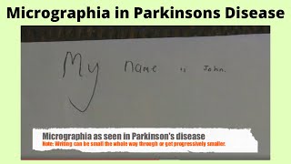 Micrographia in Parkisons disease [upl. by Athalia465]