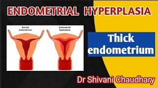 Endometrial hyperplasia  Thick endometrium heavybleeding uterus [upl. by Ytissac]