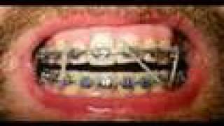 orthodontic brace power chain [upl. by Ennyroc204]