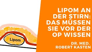 Lipome an der Stirn entfernen so wird man sie wirklich los [upl. by Coke330]