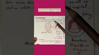 Unstable angina stable angina variant angina angina medical [upl. by Natanhoj]