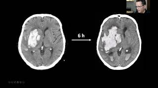 THE EANS WEBINAR INTRACEREBRAL HEMORRHAGE  NEUROSURGICAL TREATMENT PERSPECTIVES [upl. by Royo]