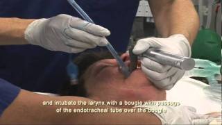 Intubation Extubation 47 [upl. by Caffrey578]