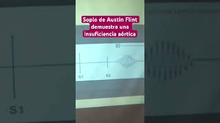 Insuficiencia Aórtica cambia la hemodinamia ventricular Soplo de Austin Flint [upl. by Oirretna]