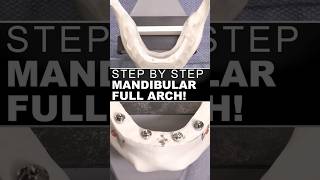 Step by Step Full Arch Mandibular All on 4 Surgery Videography [upl. by Kcarb]