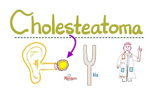 Hearing Loss Deafness  Cholesteatoma  Causes Symptoms Diagnosis amp Treatment  ENT  Pathology [upl. by Eislrahc]