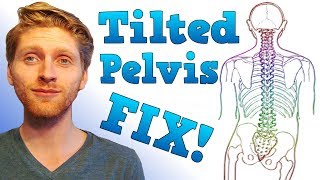 🏋️‍♂️How I mostly Fixed my Lateral Pelvic Tilt 😌 [upl. by Llerrej498]