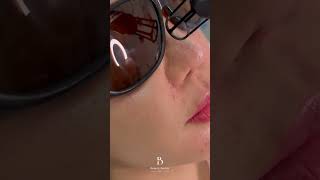 Refresh Your Skin with Erbium Treatment 💫 erbiumlaser erbiumtreatment ErbiumResurfacing [upl. by Billy339]