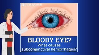 Subconjunctival Hemorrhage Blood in Eye [upl. by Solraced603]