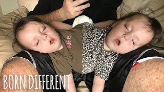 Conjoined Twins Are A Medical Miracle  BORN DIFFERENT [upl. by Abner823]