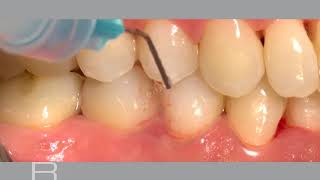 Nonsurgical treatment of periodontitis and periimplant mucositis [upl. by Wilone]