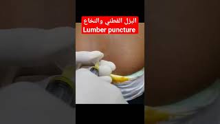 طريقة البزل القطني والنخاع lumbar puncture shorts [upl. by Tiduj12]