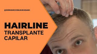 O que é a hairline no transplante capilar [upl. by Marjie447]