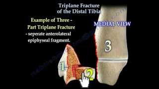 Triplane Fracture Of The Distal Tibia  Everything You Need To Know  Dr Nabil Ebraheim [upl. by Victorie]