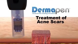 MicroNeedling for Acne Scars  Dermapen® Treatment [upl. by Auhesoj]