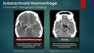 Subarachnoid Hemorrhage SAH Computed Tomography Scan Findings [upl. by Ozan]