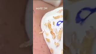 Pickel Ausdrücken Blackheads Akne amp Mitesser entfernen 🔴 46 [upl. by Lydnek863]