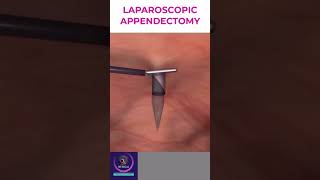 Laparoscopic Appendectomy  Appendicitis Treatment [upl. by Aniri]