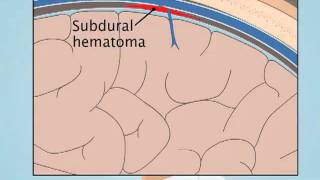 Understanding Subdural Hematoma [upl. by Agee514]