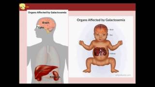 CLASE 11 metabolismo de la galactosa galactosemias [upl. by Llechtim]