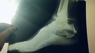 calcaneal spur orthopedics bones medicine surgery [upl. by Boleyn]