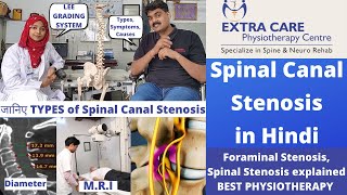 Spinal Canal Stenosis in Hindi  Types Symptoms Causes  LEE Grading System  BEST PHYSIOTHERAPY [upl. by Mitzie]