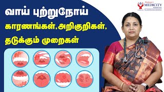 வாய் புற்றுநோய் காரணங்கள் அறிகுறிகள்தடுக்கும் முறைகள்  Oral Cancer [upl. by Aili]