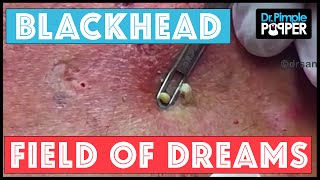 Blackhead Field of Dreams Supercomedones amp Dilated Pores of Winer [upl. by Cordeelia]