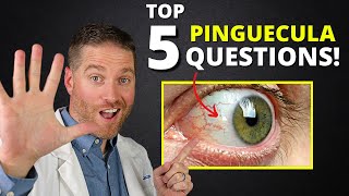 Yellow Spot On Your Eye Pinguecula  Top 5 Questions Answered [upl. by Aloel]