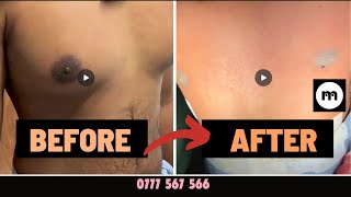 Do you want to see gynecomastia surgery results from 1 centre for gynecomastia treatments [upl. by Mcintyre]