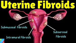 Uterine Fibroids Types Symptoms Causes Diagnosis Treatment and Complications [upl. by Ruthanne]