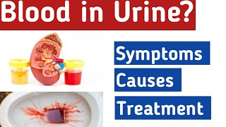 Blood in the urine  Hematuria Types Causes Symptoms Diagnosis Treatment [upl. by Suoivatram837]