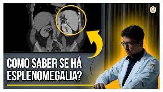 Como Identificar HIPERTENSÃO PORTAL e ESPLENOMEGALIA [upl. by Learrsi555]