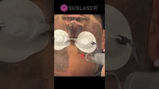 SUSLASER Face Carbon Peeling For Whitening amp Deep Pores Cleaning Men Can Make SKin Looks Good TOO [upl. by Renzo]